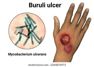 NTDs: Increased Effort Needed to Improve Diagnosis of Buruli Ulcer